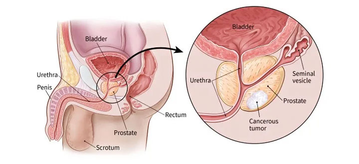 Best Doctor For Prostate Disease Treatment in Mulund